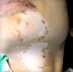 Vitiligo treatment