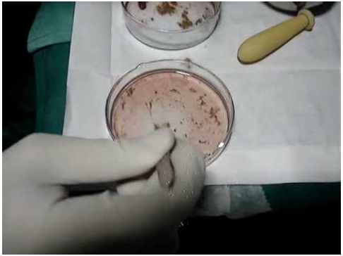 Vitiligo Treatment in Delhi