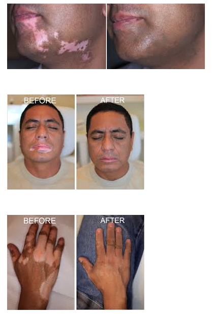 Vitiligo Treatment in Delhi