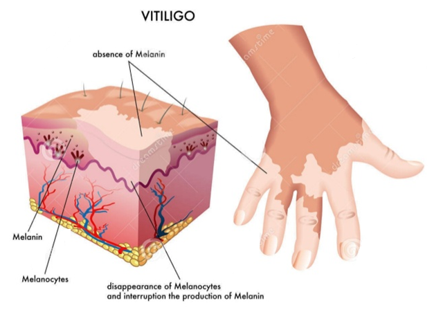 Vitiligo Treatment in Delhi