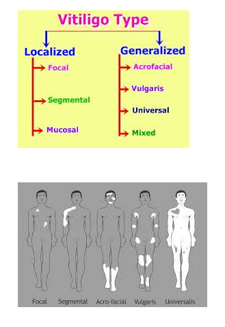 Vitiligo Treatment in Delhi