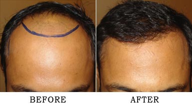 hair transplant in delhi