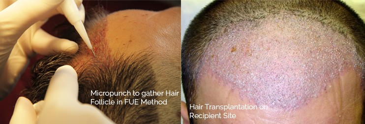 Hair transplantation before & after