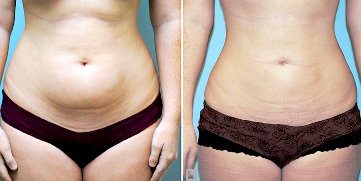 Liposuction of flanks Care Well Medical Centre