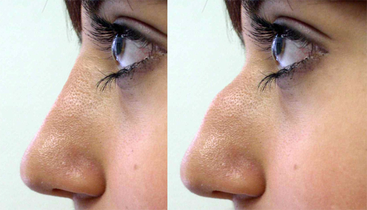 Nose Correction Surgery