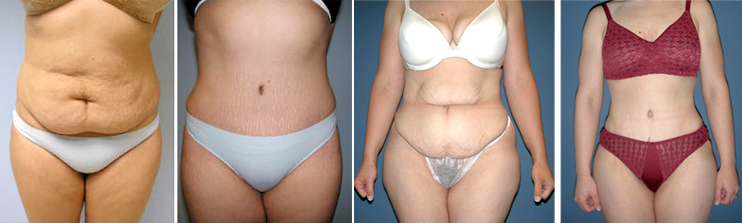 http://www.carewellmedicalcentre.in/images/tummy-tuck.jpg