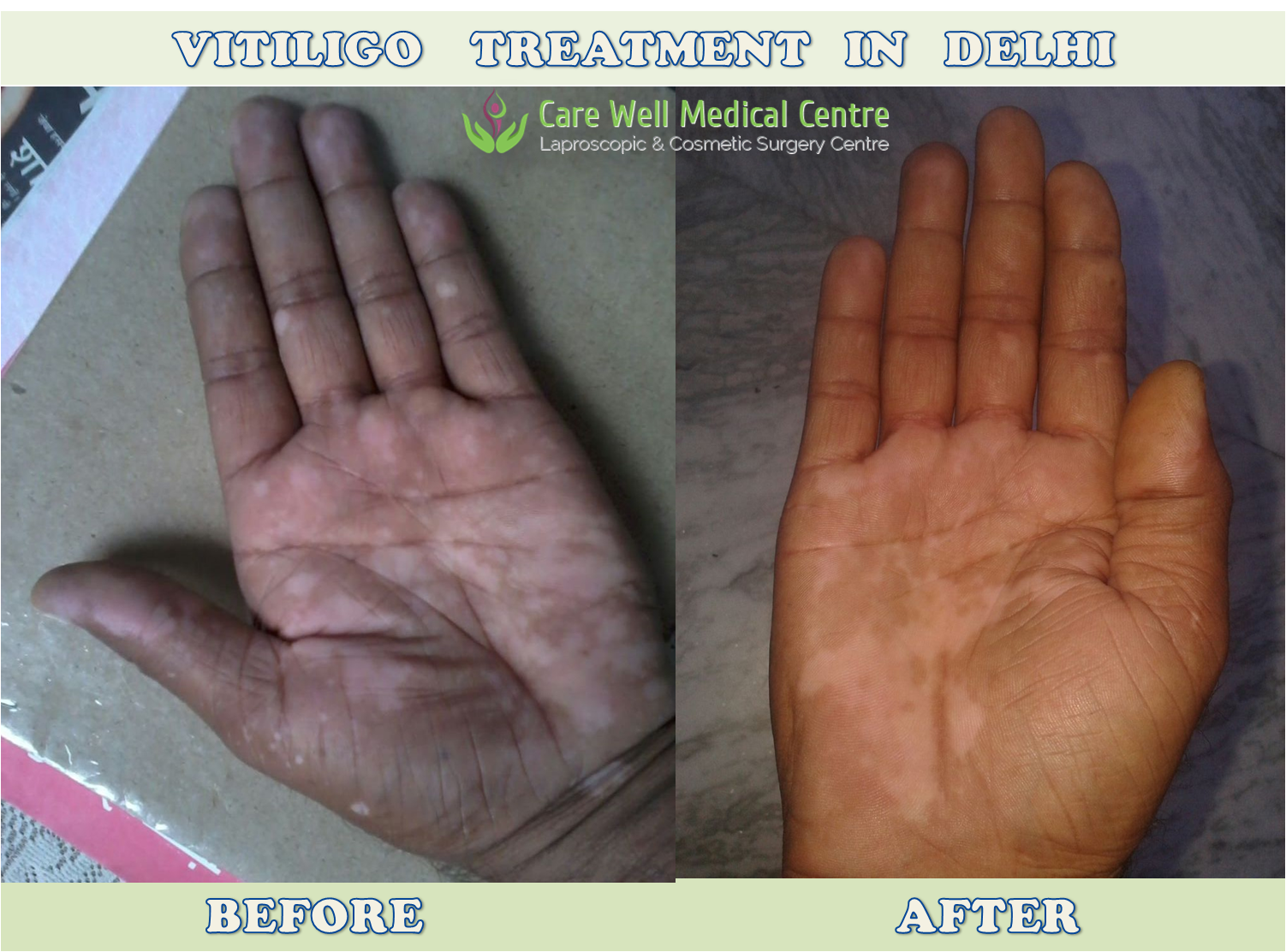 Vitligo Surgery