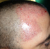 FUE Hair transplantation