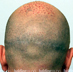 Hair Transplant Surgery